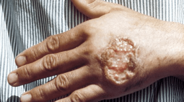 Leishmaniasis